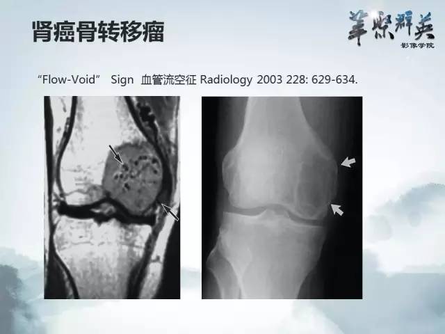 【病例】胫骨高分化骨肉瘤1例X线CT及MR影像表现