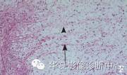【病例】左臀部黏液性纤维肉瘤1例MR