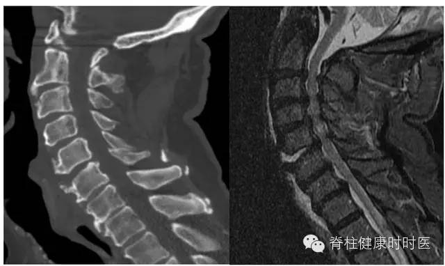 椎体骨折是否一定存在骨髓水肿呢？