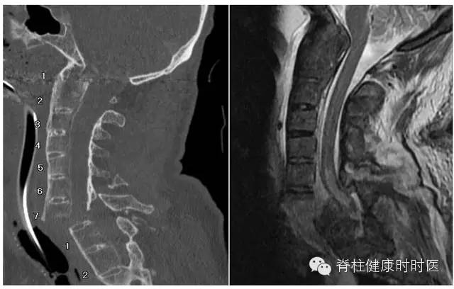 椎体骨折是否一定存在骨髓水肿呢? 椎体骨折是否一定存在骨髓水肿呢?