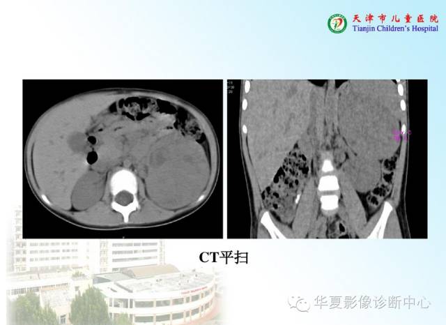 【病例】腹膜后内胚窦瘤1例CT影像表现