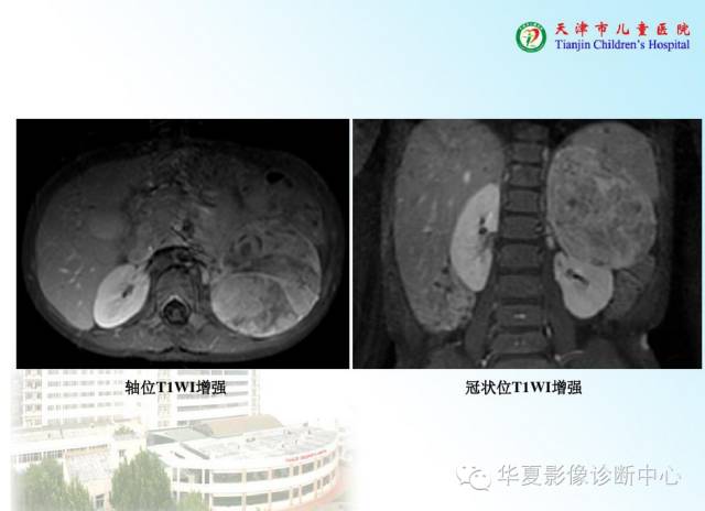 【病例】腹膜后内胚窦瘤1例CT影像表现
