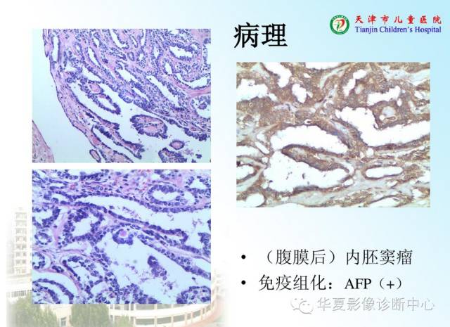 【病例】腹膜后内胚窦瘤1例CT影像表现
