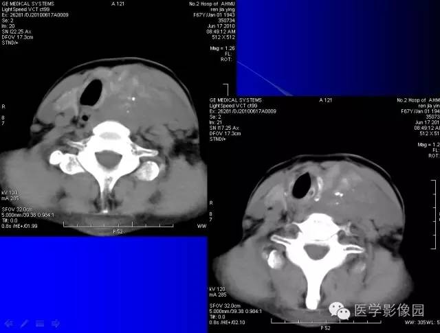 【病例】甲状腺癌1例CT影像表现 【病例】甲状腺癌1例CT影像表现
