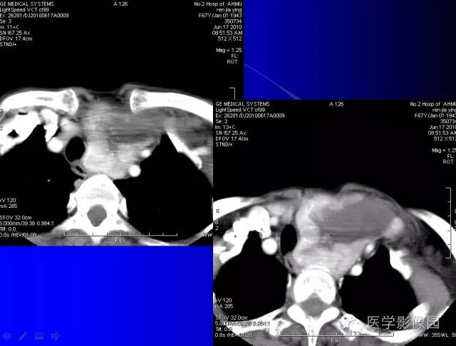 【病例】甲状腺癌1例CT影像表现 【病例】甲状腺癌1例CT影像表现