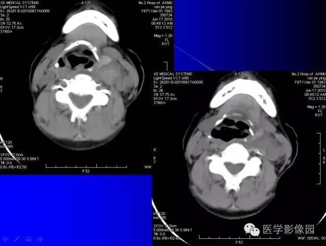 【病例】甲状腺癌1例CT影像表现 【病例】甲状腺癌1例CT影像表现