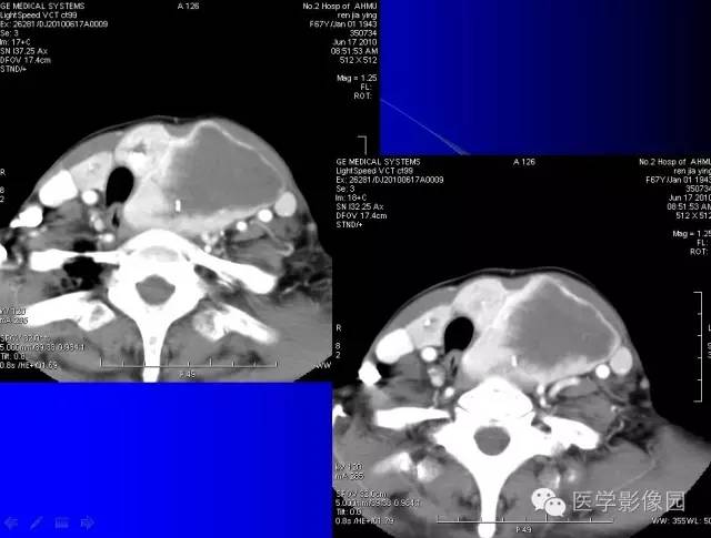 【病例】甲状腺癌1例CT影像表现 【病例】甲状腺癌1例CT影像表现