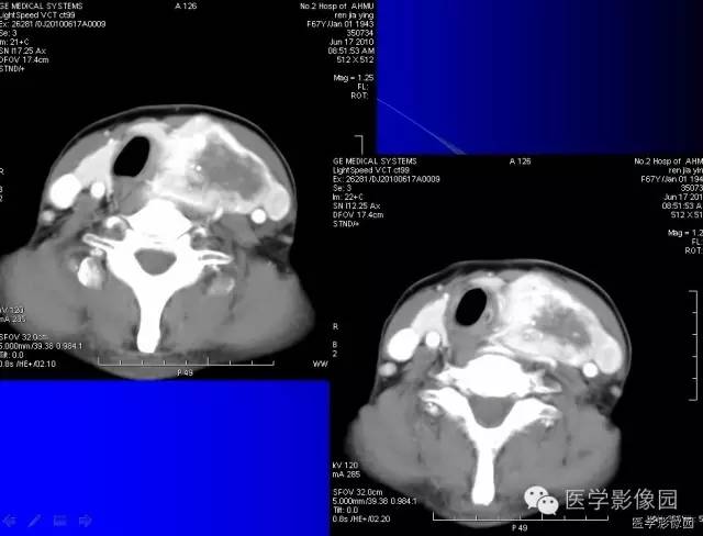 【病例】甲状腺癌1例CT影像表现 【病例】甲状腺癌1例CT影像表现