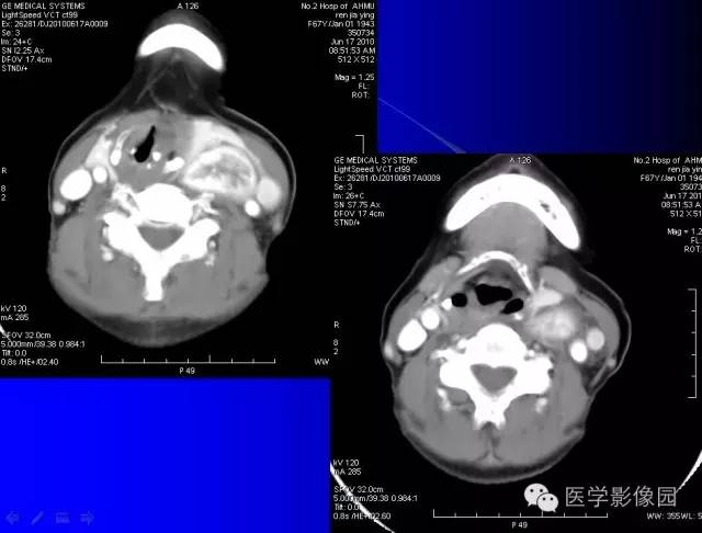 【病例】甲状腺癌1例CT影像表现 【病例】甲状腺癌1例CT影像表现
