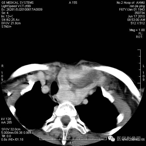 【病例】甲状腺癌1例CT影像表现 【病例】甲状腺癌1例CT影像表现