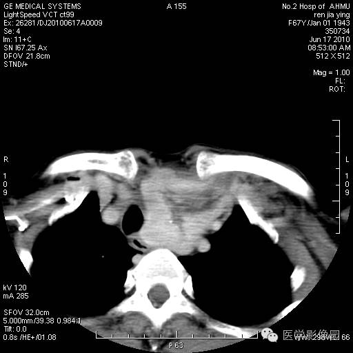 【病例】甲状腺癌1例CT影像表现 【病例】甲状腺癌1例CT影像表现