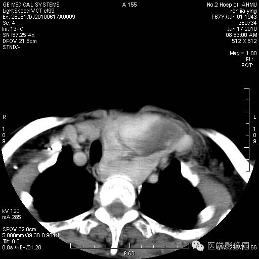 【病例】甲状腺癌1例CT影像表现 【病例】甲状腺癌1例CT影像表现