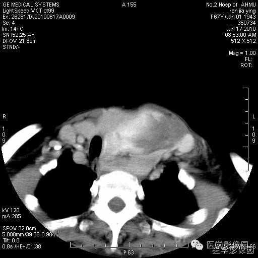 【病例】甲状腺癌1例CT影像表现 【病例】甲状腺癌1例CT影像表现