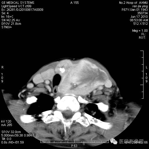 【病例】甲状腺癌1例CT影像表现 【病例】甲状腺癌1例CT影像表现