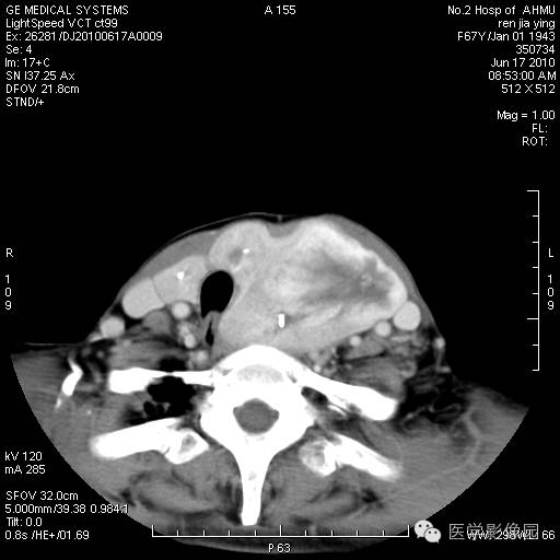 【病例】甲状腺癌1例CT影像表现 【病例】甲状腺癌1例CT影像表现