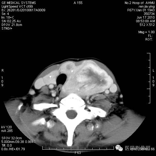 【病例】甲状腺癌1例CT影像表现 【病例】甲状腺癌1例CT影像表现
