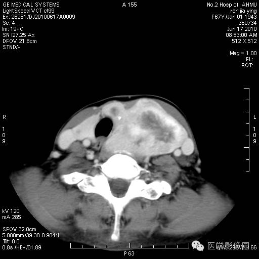 【病例】甲状腺癌1例CT影像表现 【病例】甲状腺癌1例CT影像表现