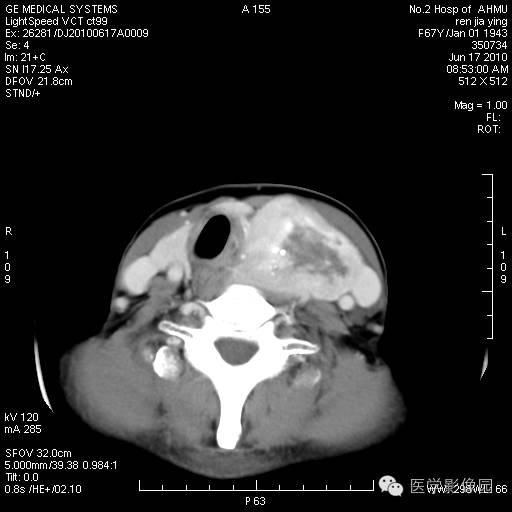 【病例】甲状腺癌1例CT影像表现 【病例】甲状腺癌1例CT影像表现