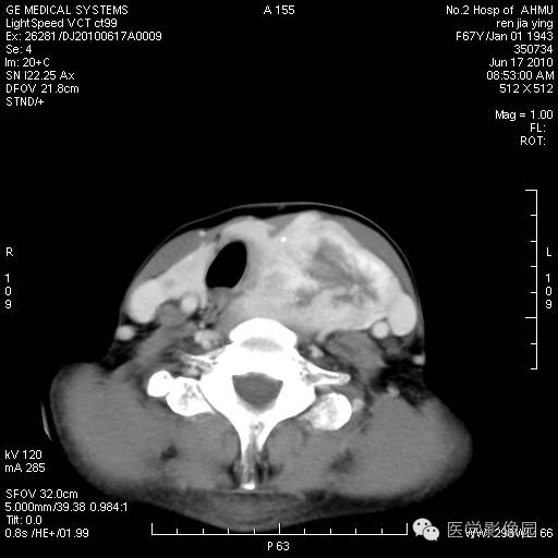 【病例】甲状腺癌1例CT影像表现 【病例】甲状腺癌1例CT影像表现