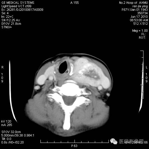 【病例】甲状腺癌1例CT影像表现 【病例】甲状腺癌1例CT影像表现