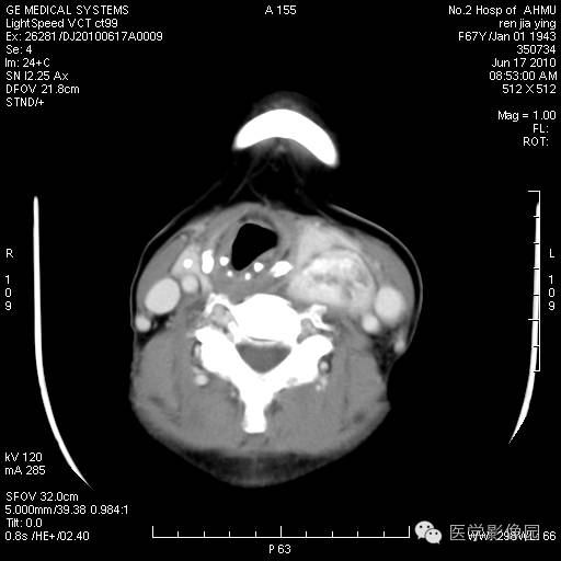 【病例】甲状腺癌1例CT影像表现 【病例】甲状腺癌1例CT影像表现