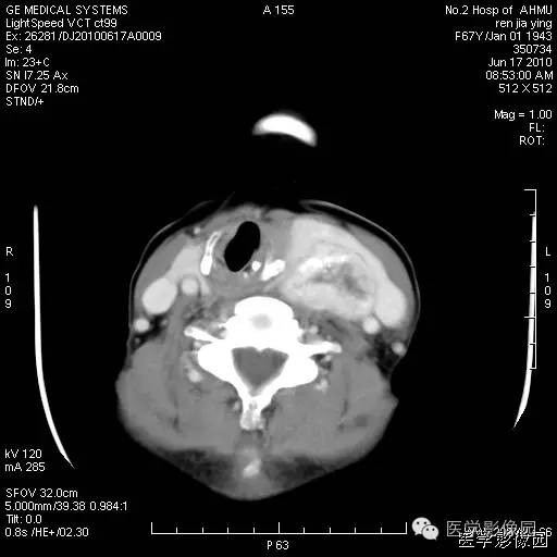 【病例】甲状腺癌1例CT影像表现 【病例】甲状腺癌1例CT影像表现