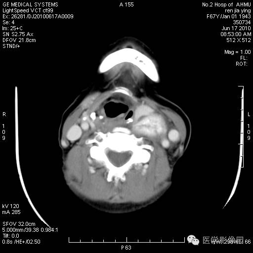 【病例】甲状腺癌1例CT影像表现 【病例】甲状腺癌1例CT影像表现