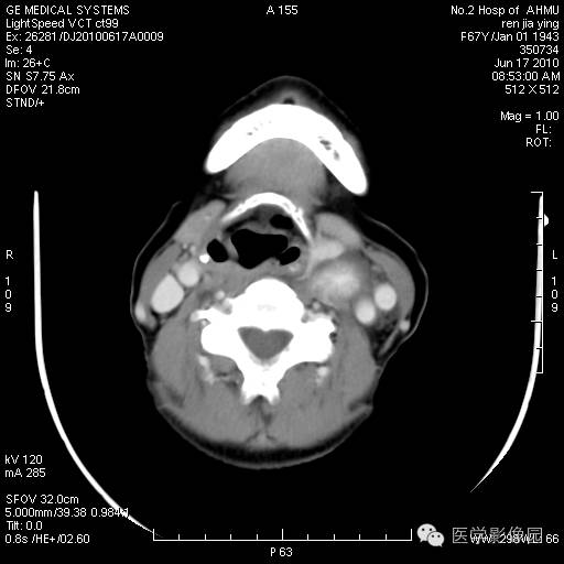 【病例】甲状腺癌1例CT影像表现 【病例】甲状腺癌1例CT影像表现