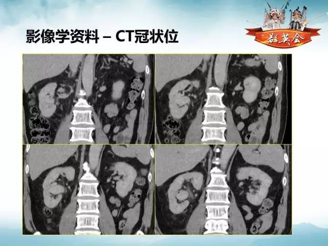 【病例】右肾血管瘤1例CT及MR影像分析