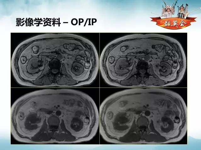 【病例】右肾血管瘤1例CT及MR影像分析