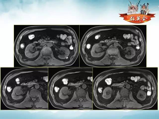 【病例】右肾血管瘤1例CT及MR影像分析