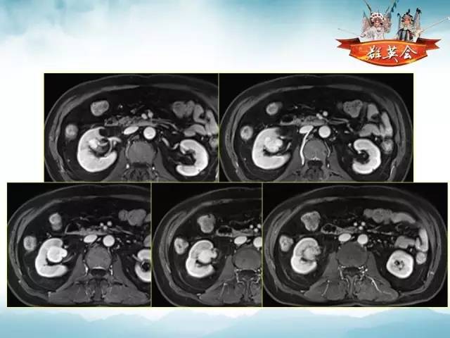【病例】右肾血管瘤1例CT及MR影像分析