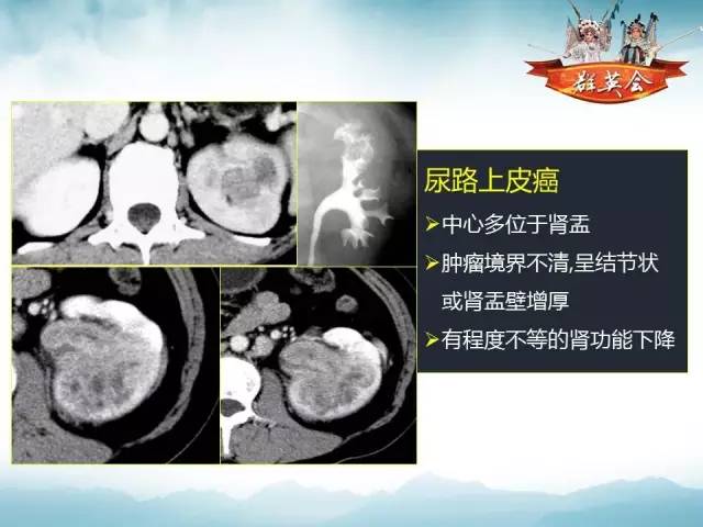 【病例】右肾血管瘤1例CT及MR影像分析