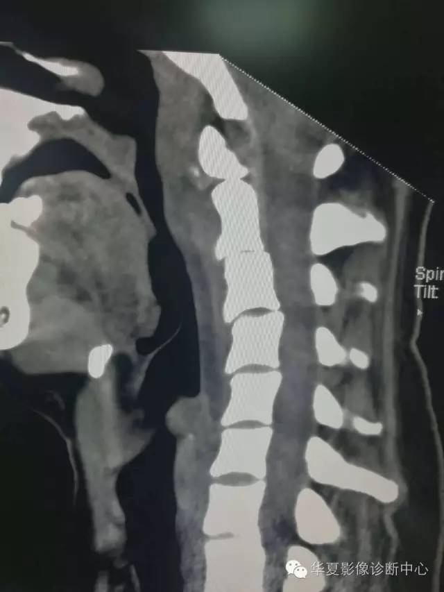 颈长肌肌腱炎