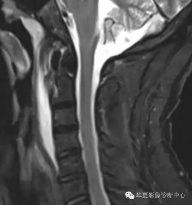 颈长肌肌腱炎