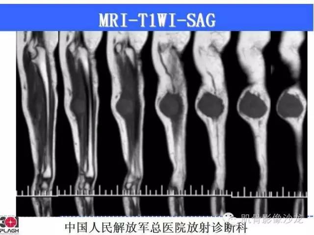 【病例】横纹肌肉瘤2例MR病例讨论 【病例】横纹肌肉瘤2例MR病例讨论