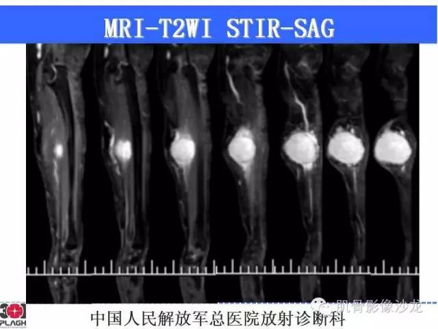 【病例】横纹肌肉瘤2例MR病例讨论 【病例】横纹肌肉瘤2例MR病例讨论