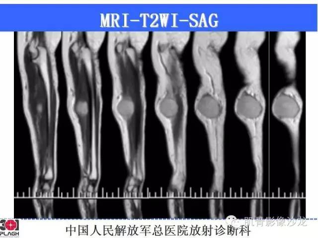 【病例】横纹肌肉瘤2例MR病例讨论 【病例】横纹肌肉瘤2例MR病例讨论