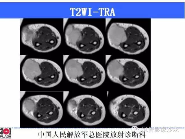 【病例】横纹肌肉瘤2例MR病例讨论 【病例】横纹肌肉瘤2例MR病例讨论