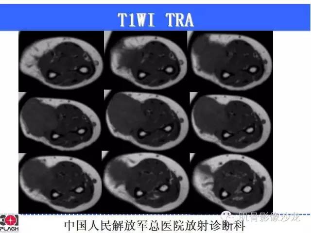 【病例】横纹肌肉瘤2例MR病例讨论 【病例】横纹肌肉瘤2例MR病例讨论