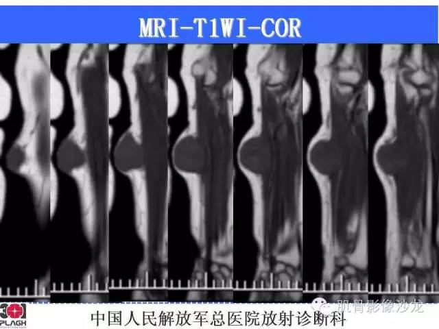 【病例】横纹肌肉瘤2例MR病例讨论 【病例】横纹肌肉瘤2例MR病例讨论