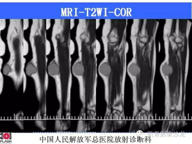 【病例】横纹肌肉瘤2例MR病例讨论 【病例】横纹肌肉瘤2例MR病例讨论