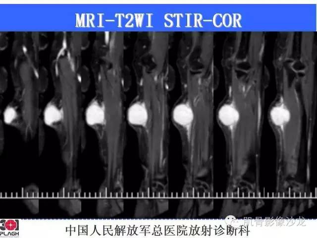 【病例】横纹肌肉瘤2例MR病例讨论 【病例】横纹肌肉瘤2例MR病例讨论