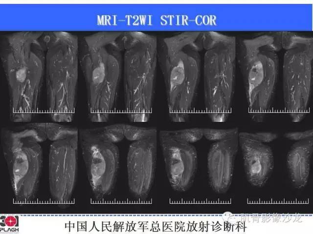 【病例】横纹肌肉瘤2例MR病例讨论 【病例】横纹肌肉瘤2例MR病例讨论