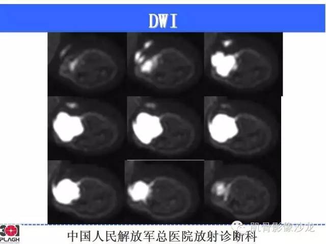 【病例】横纹肌肉瘤2例MR病例讨论 【病例】横纹肌肉瘤2例MR病例讨论