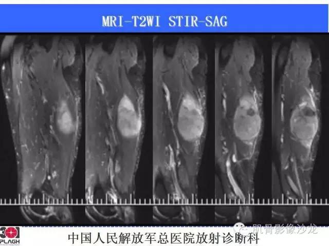 【病例】横纹肌肉瘤2例MR病例讨论 【病例】横纹肌肉瘤2例MR病例讨论