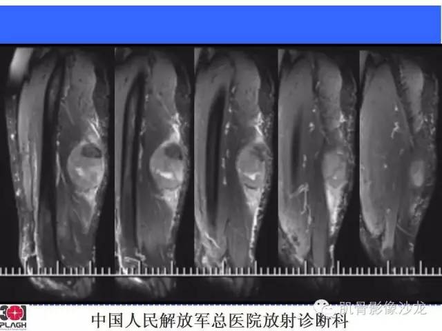 【病例】横纹肌肉瘤2例MR病例讨论 【病例】横纹肌肉瘤2例MR病例讨论