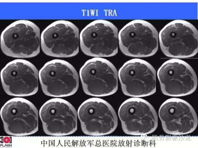 【病例】横纹肌肉瘤2例MR病例讨论 【病例】横纹肌肉瘤2例MR病例讨论