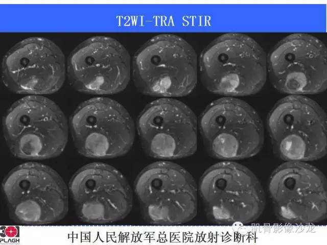 【病例】横纹肌肉瘤2例MR病例讨论 【病例】横纹肌肉瘤2例MR病例讨论