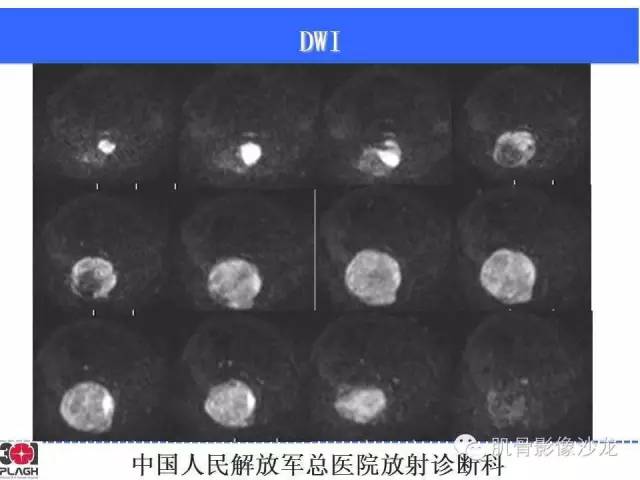 【病例】横纹肌肉瘤2例MR病例讨论 【病例】横纹肌肉瘤2例MR病例讨论